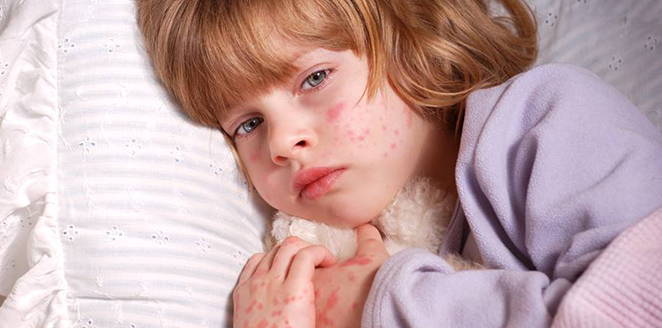 Approach to Child with Rash II